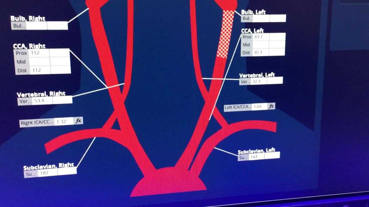 Video: Carotid Artery Reporting Template Example | Daic With Carotid Ultrasound Report Template